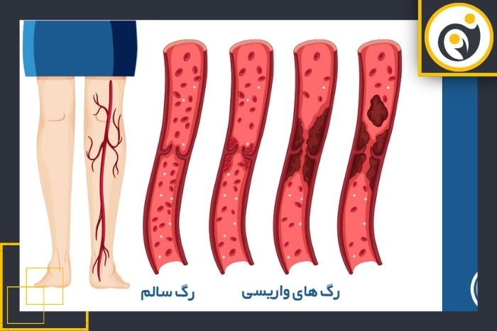 چه عواملی می‌توانند دقت سونوگرافی کالر داپلر را کاهش دهند؟