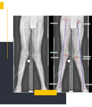 رادیوگرافی الایمنت ویو (Alignment View) رادیوگرافی الایمنت ویو (Alignment View)
