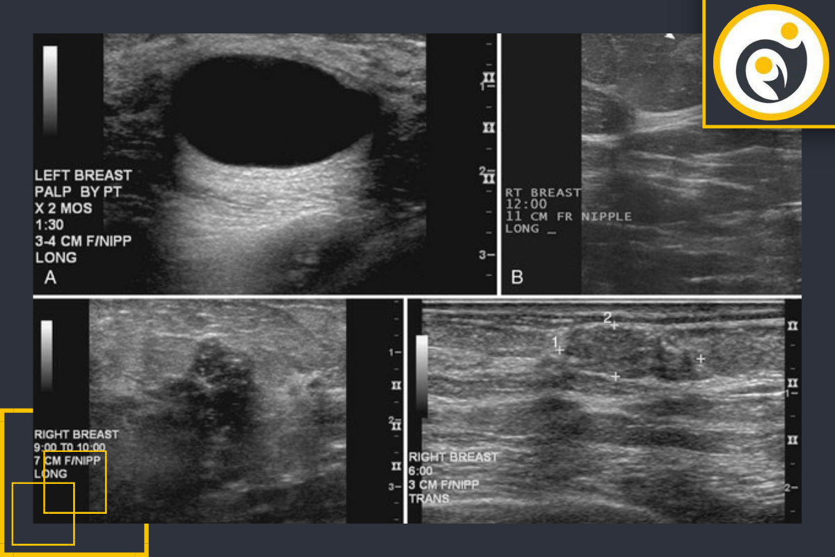 سونوگرافی سینه چیست؟