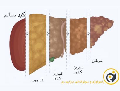 فیبرواسکن