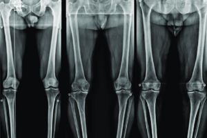 رادیوگرافی الایمنت ویو 