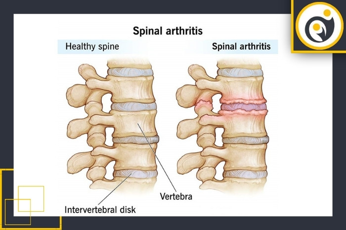 آرتروز ستون فقرات و محدودیت حرکت