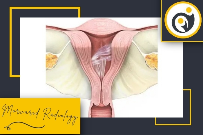 آیا سونوگرافی رحم می‌تواند چسبندگی داخل رحم را نشان دهد؟