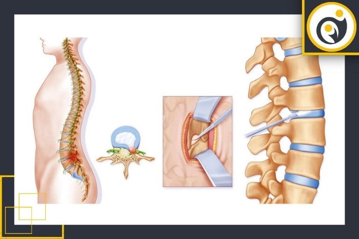 بهترین زمان تصویربرداری تکمیلی بعد از جراحی دیسک کمر