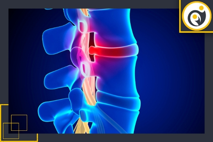 تشخیص دیسک کمر با رادیوگرافی یا MRI تشخیص دیسک کمر با رادیوگرافی یا MRI