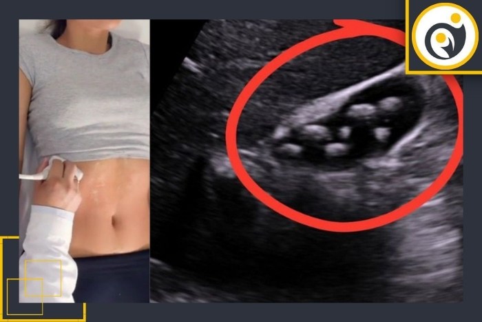 تشخیص سنگ صفرا با سونوگرافی تشخیص سنگ صفرا با سونوگرافی