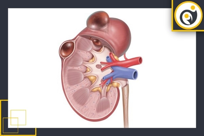 خطر کیست ساده کلیه