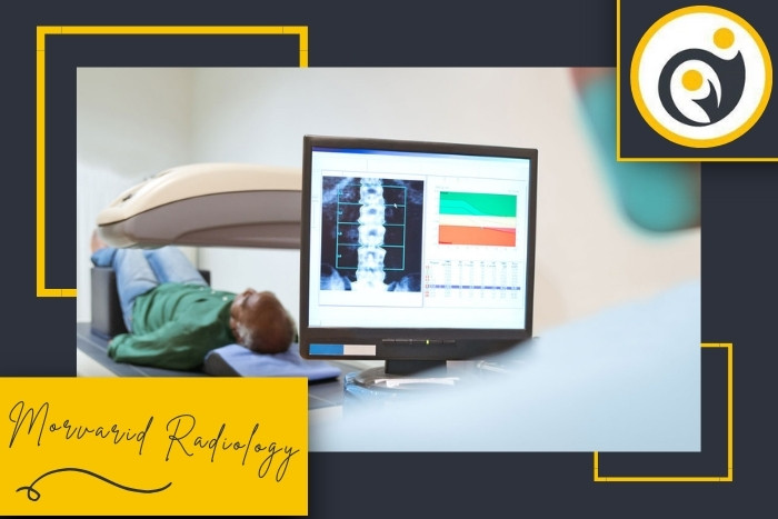 در سنجش تراکم استخوان چه عددی به معنای پوکی استخوان است؟