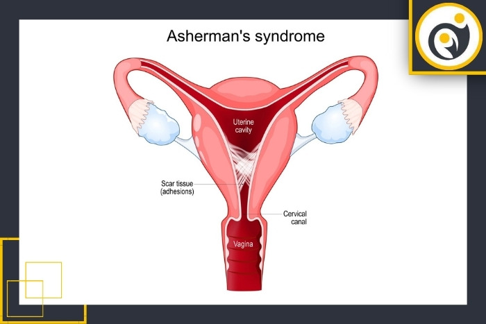 آیا سندرم آشرمن قابل درمان است؟ آیا سندرم آشرمن قابل درمان است؟