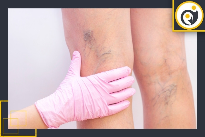 روش های تشخیص واریس پا روش های تشخیص واریس پا