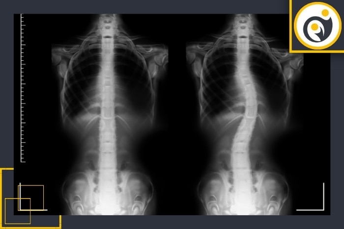 روش‌های تشخیص انحراف ستون فقرات
