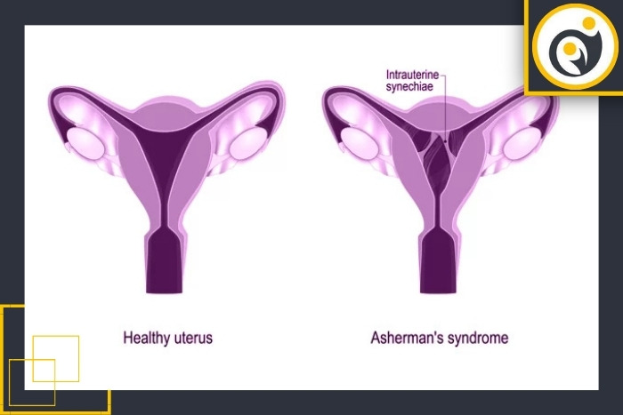 شایع‌ترین علل سندرم آشرمن