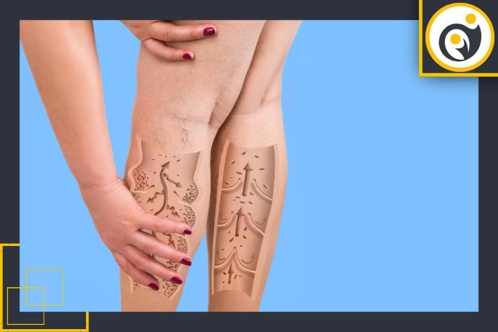 علائم واریس پا علائم واریس پا