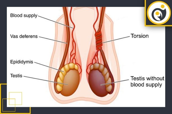 علائم پیچ خوردگی بیضه