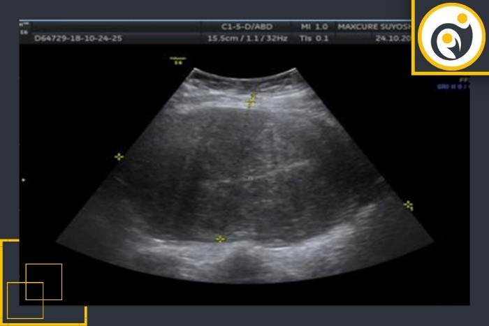 علت بزرگی رحم در سونوگرافی علت بزرگی رحم در سونوگرافی