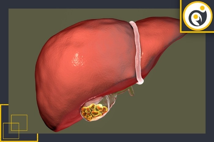 علل ایجاد سنگهای صفراوی علل ایجاد سنگهای صفراوی