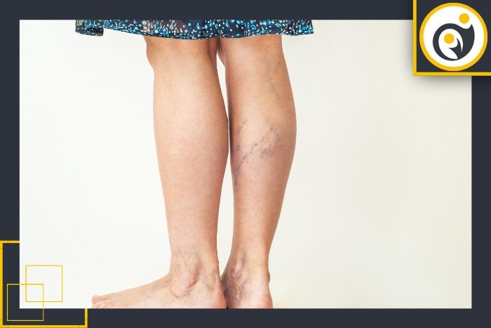 عوامل مؤثر در بروز رگ های واریسی عوامل مؤثر در بروز رگ های واریسی