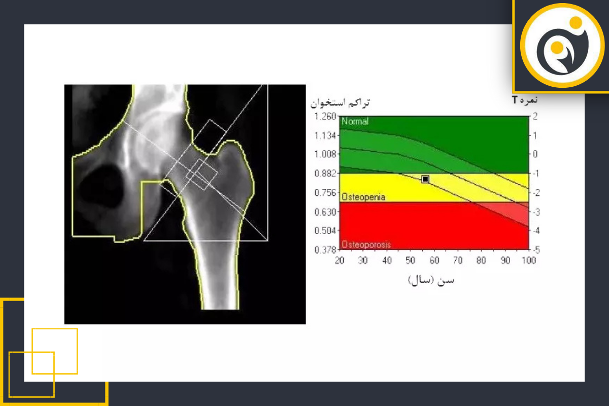 اهمیت انجام تست تراکم استخوان