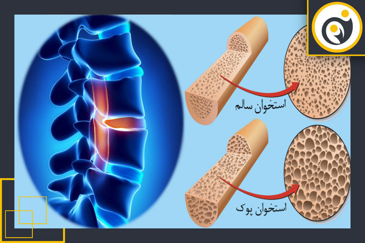 نکات قبل از انجام Bone Densitometry