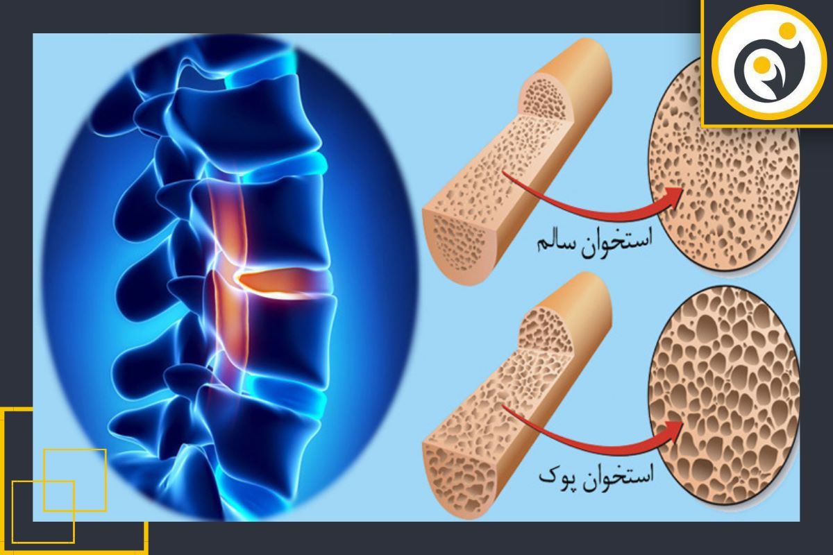 نکات قبل از انجام Bone Densitometry نکات قبل از انجام Bone Densitometry