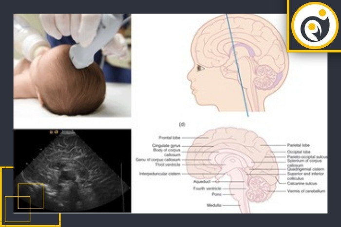 نحوه انجام سونوی نوزاد نارس نحوه انجام سونوی نوزاد نارس