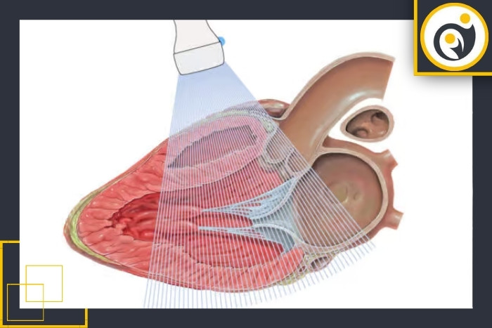 نقش سونوگرافی رنگی در تشخیص بیماری‌های قلبی