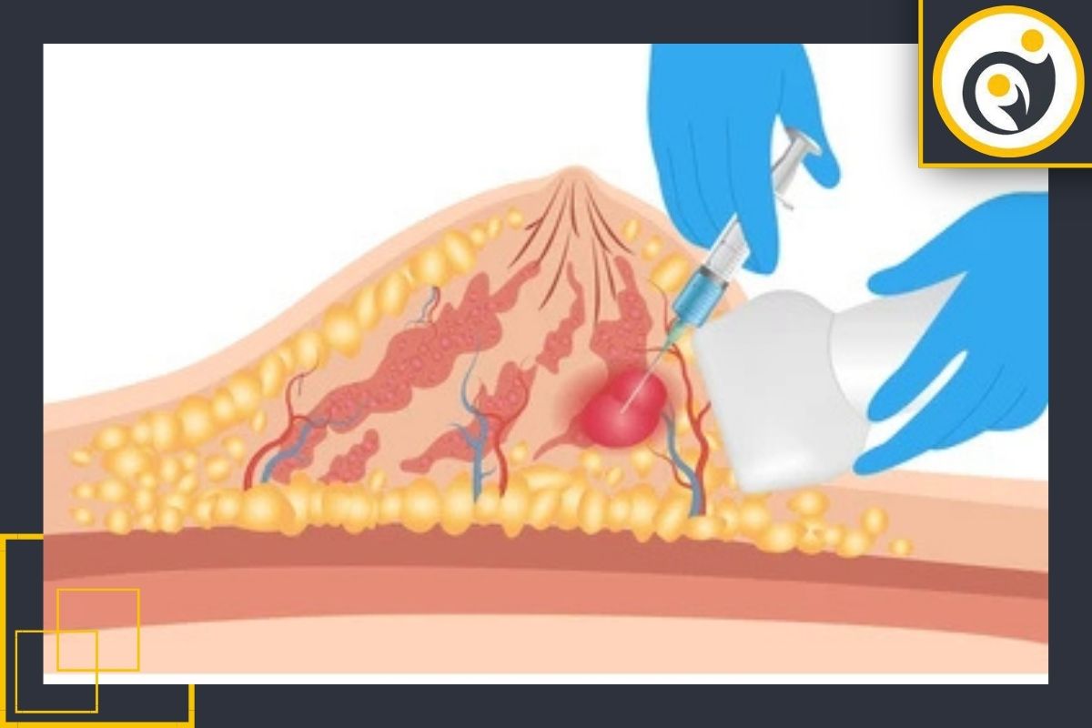 انواع روش‌های بیوپسی پستان