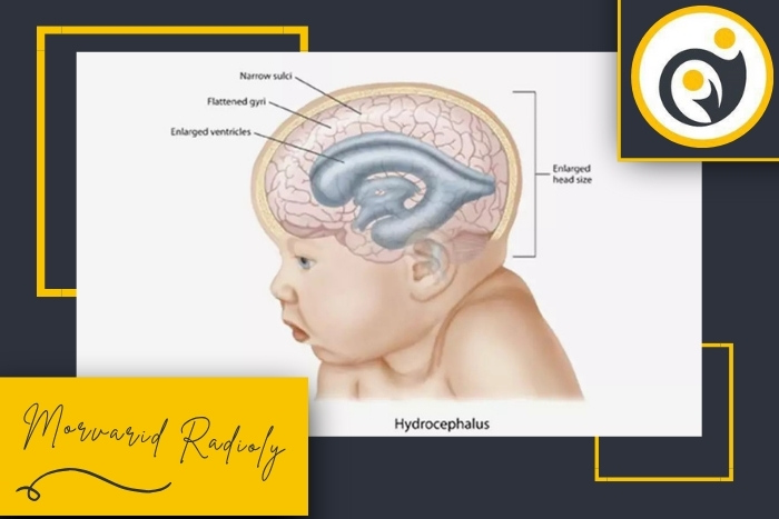 آیا سونوگرافی می‌تواند هیدروسفالی را در بدو تولد تشخیص دهد؟
