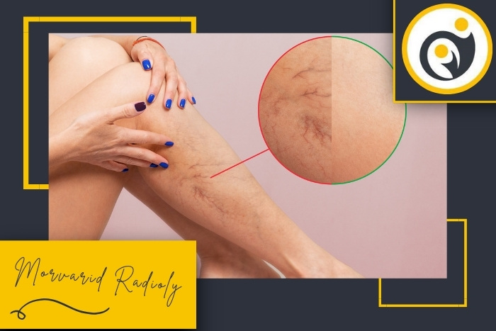 واریس پا چه علائمی دارد و با چه روش هایی تشخیص داده می شود؟