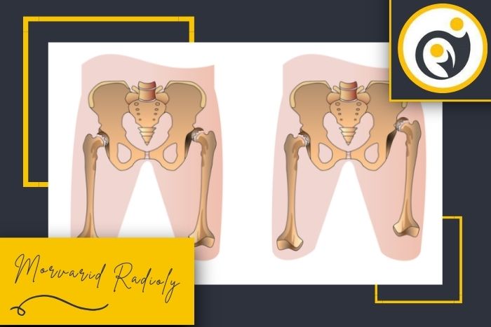 چطور علائم دررفتگی لگن نوزاد را به موقع تشخیص دهیم؟