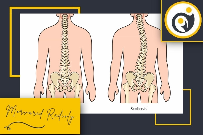چگونه اسکولیوز بر وضعیت ستون فقرات تاثیر می‌گذارد؟